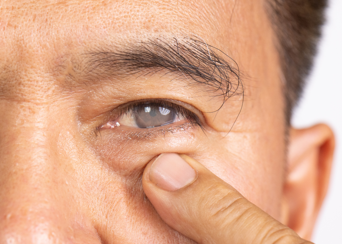 Phacoemulsification Cataract Surgery