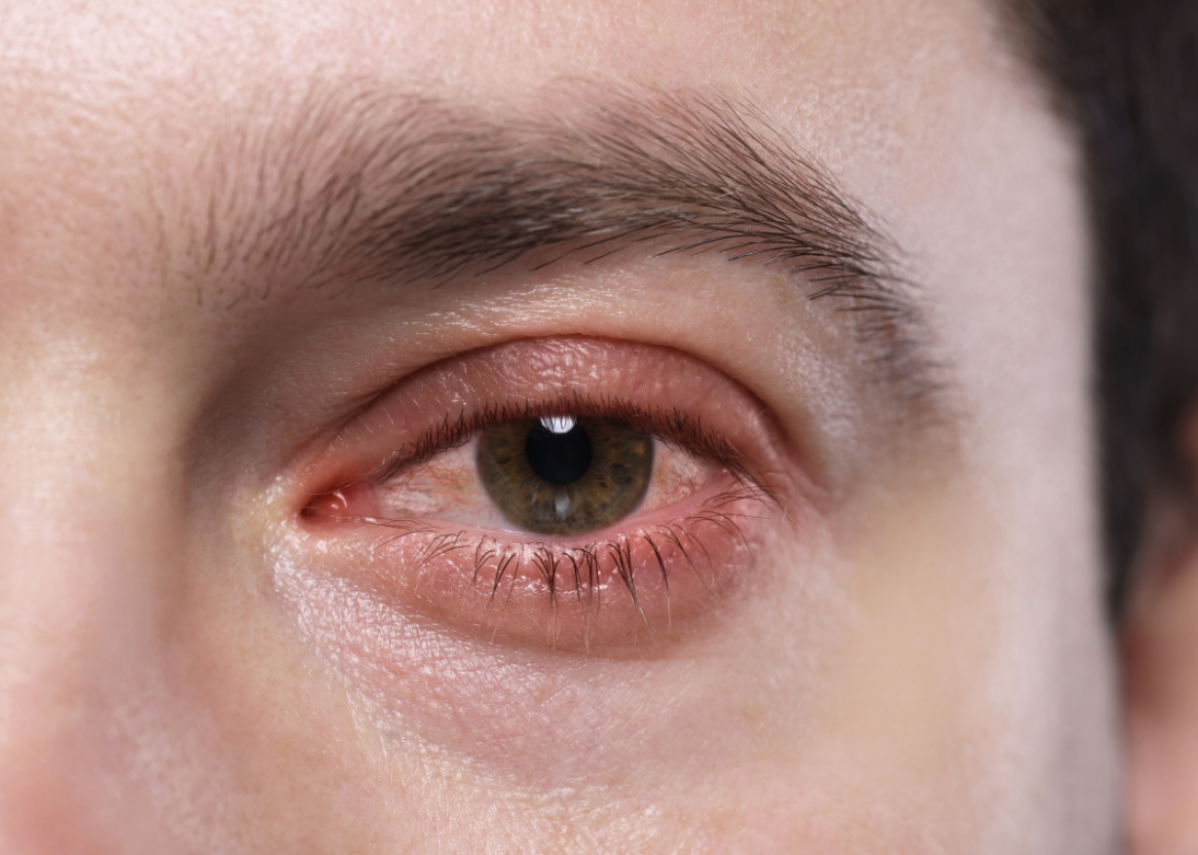 Glaucoma Management & Surgery